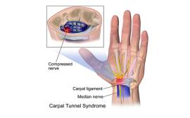 Tips for managing carpal tunnel syndrome when cycling