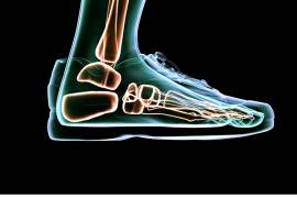 Can I continue training with foot osteoarthritis?