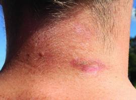 10 irritating minor tri ailments and how to treat them