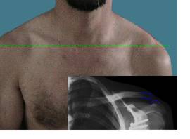 How can I treat a grade-3 shoulder separation injury without surgery?