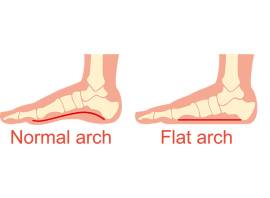 Fallen arches: what are they?