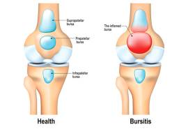 Knee bursitis: what it is and how to treat it