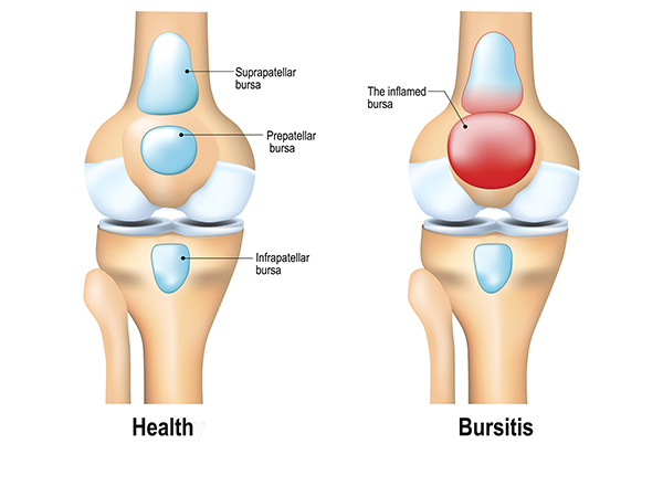 Knee bursitis: what it is and how to treat it