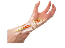 Carpal tunnel syndrome: what it is and how to treat/prevent it