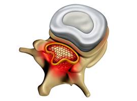 Spinal stenosis: what it is and how to treat it
