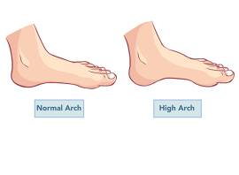High foot arches: what they are and how to treat the problems they cause