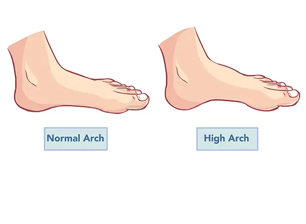 High foot arches: what they are and how to treat the problems they cause