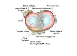 What is a torn meniscus and how do you treat it?