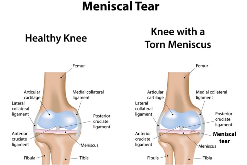 Meniscal tear illustration